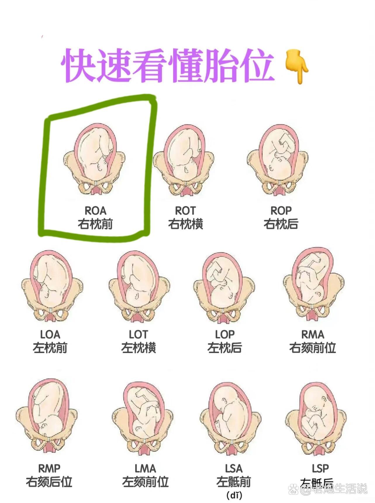 lsa胎位臀位肚子图片图片