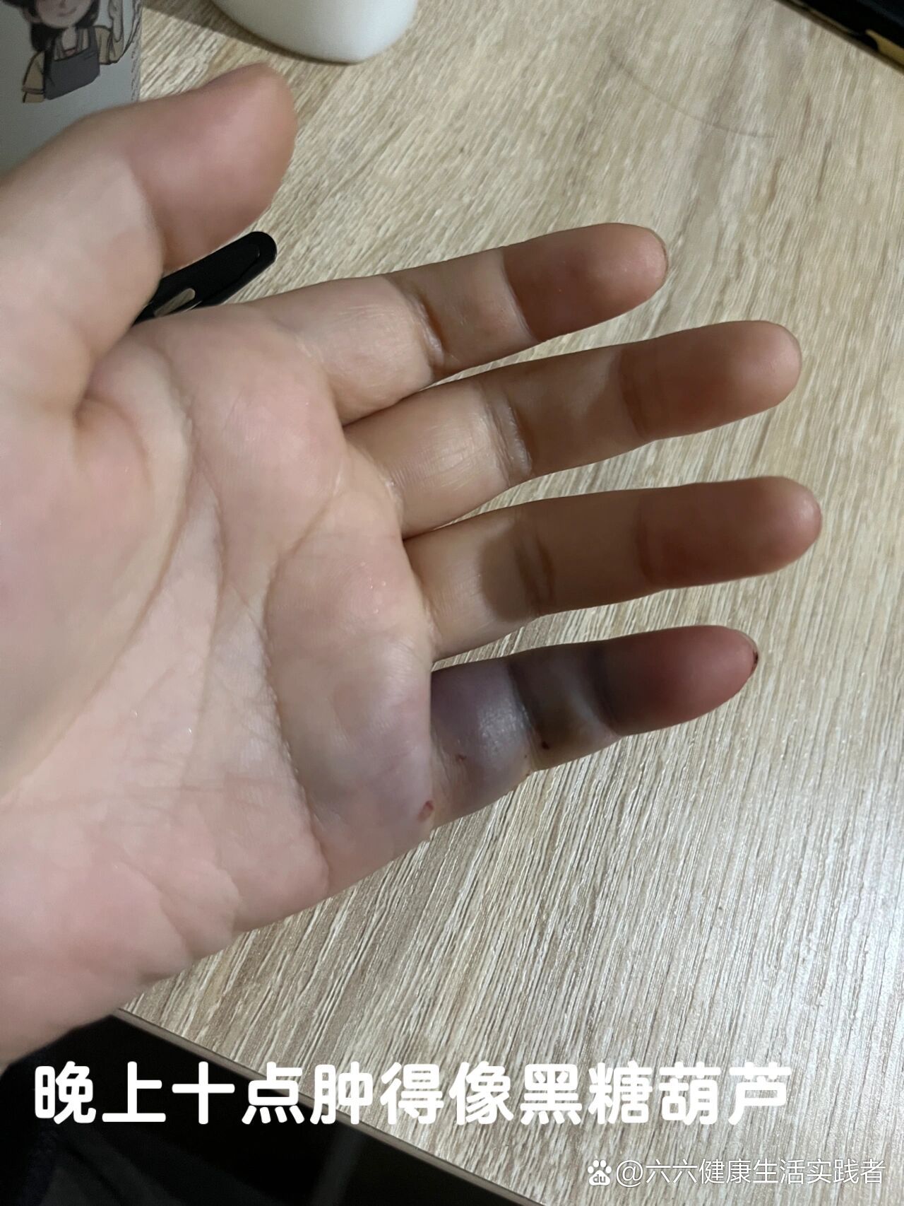 小拇指近节指骨基底部骨折