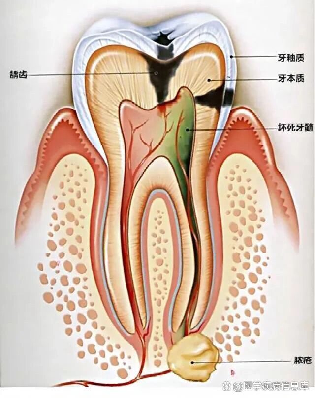 牙髓位置图图片