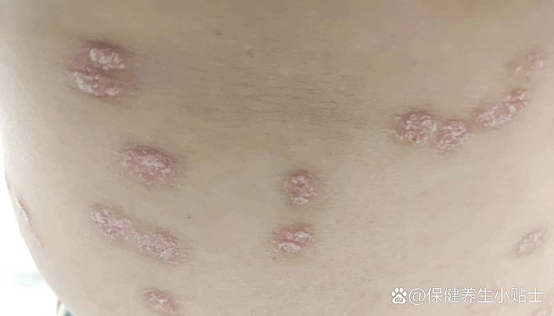银屑病生物制剂特诺雅第一针