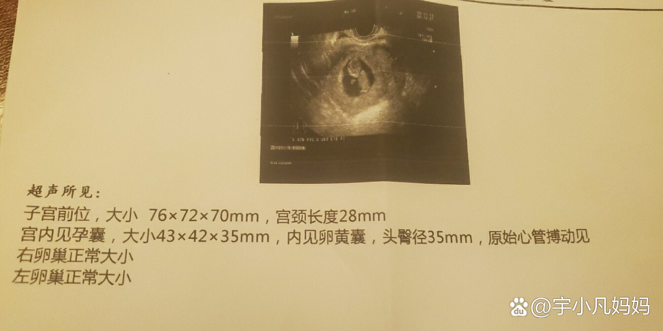 怀孕10周女孩孕囊图图片