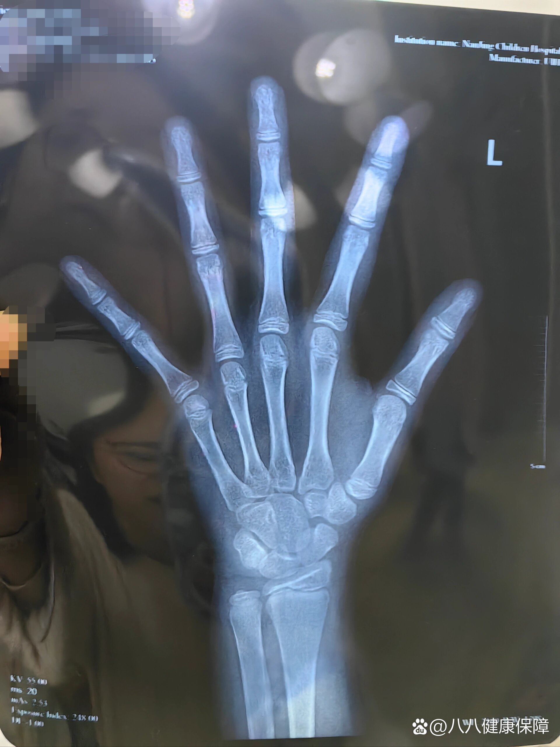 9岁女孩骨龄11,还有可能长到1米6吗?