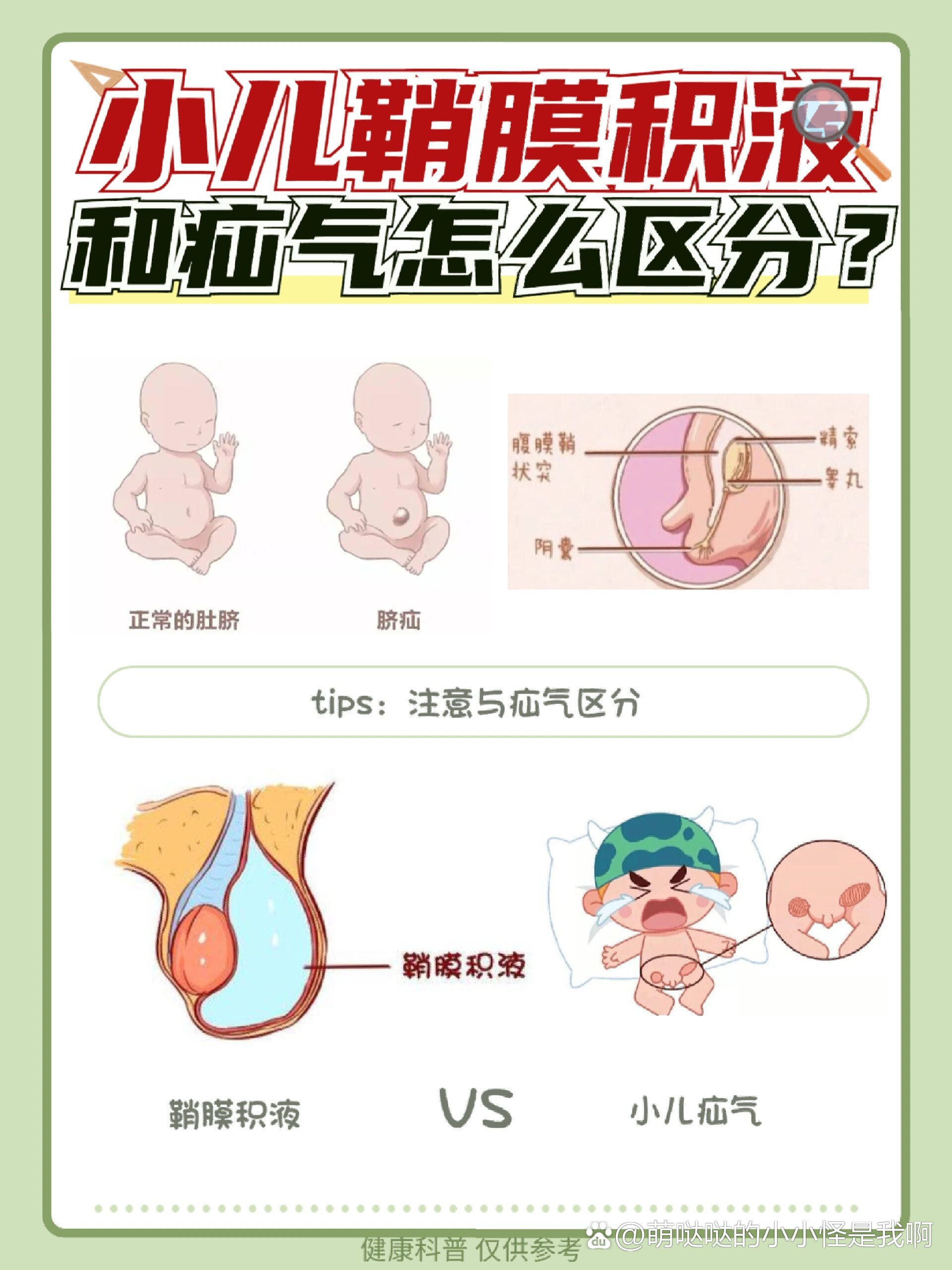 新生儿鞘膜积液图片图片