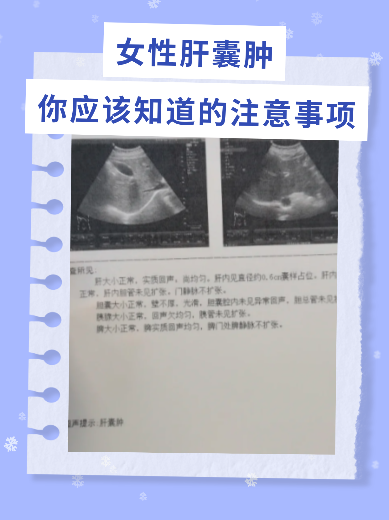 女性肝囊肿:你应该知道的注意事项