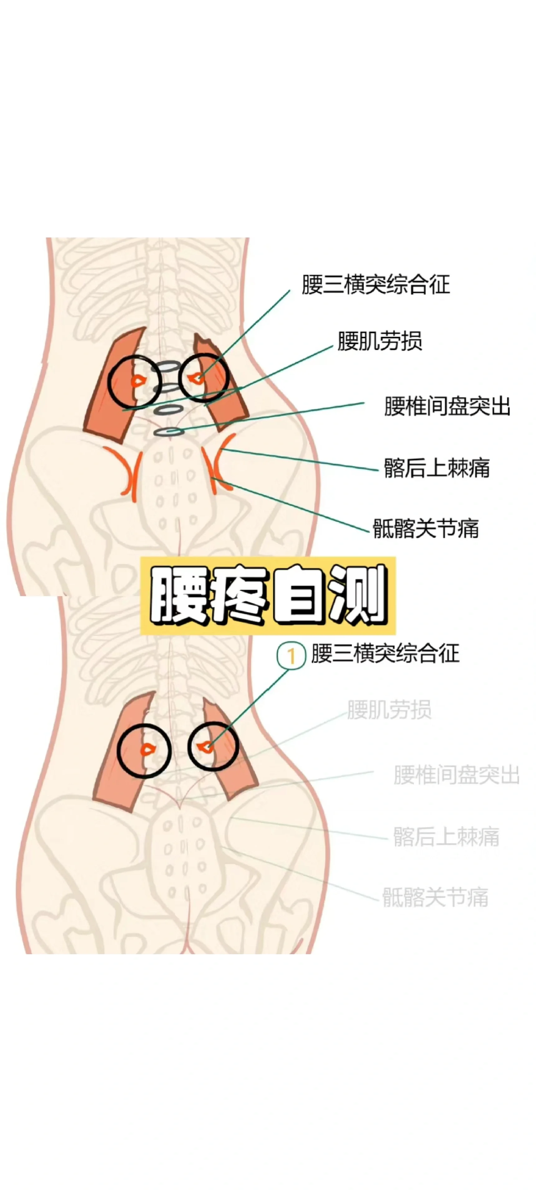 髂后上棘定位图图解图片