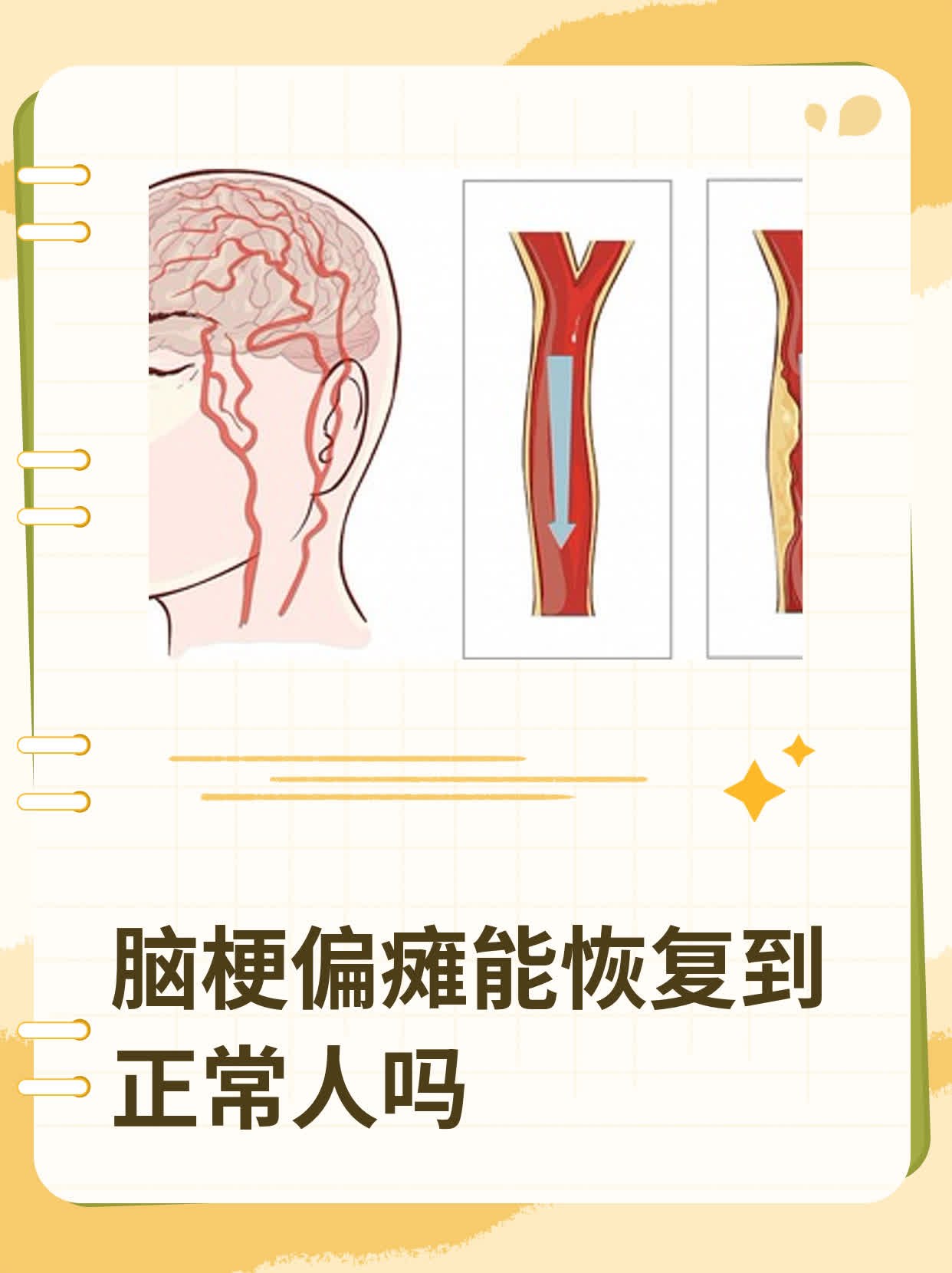 脑梗偏瘫能恢复到正常人吗