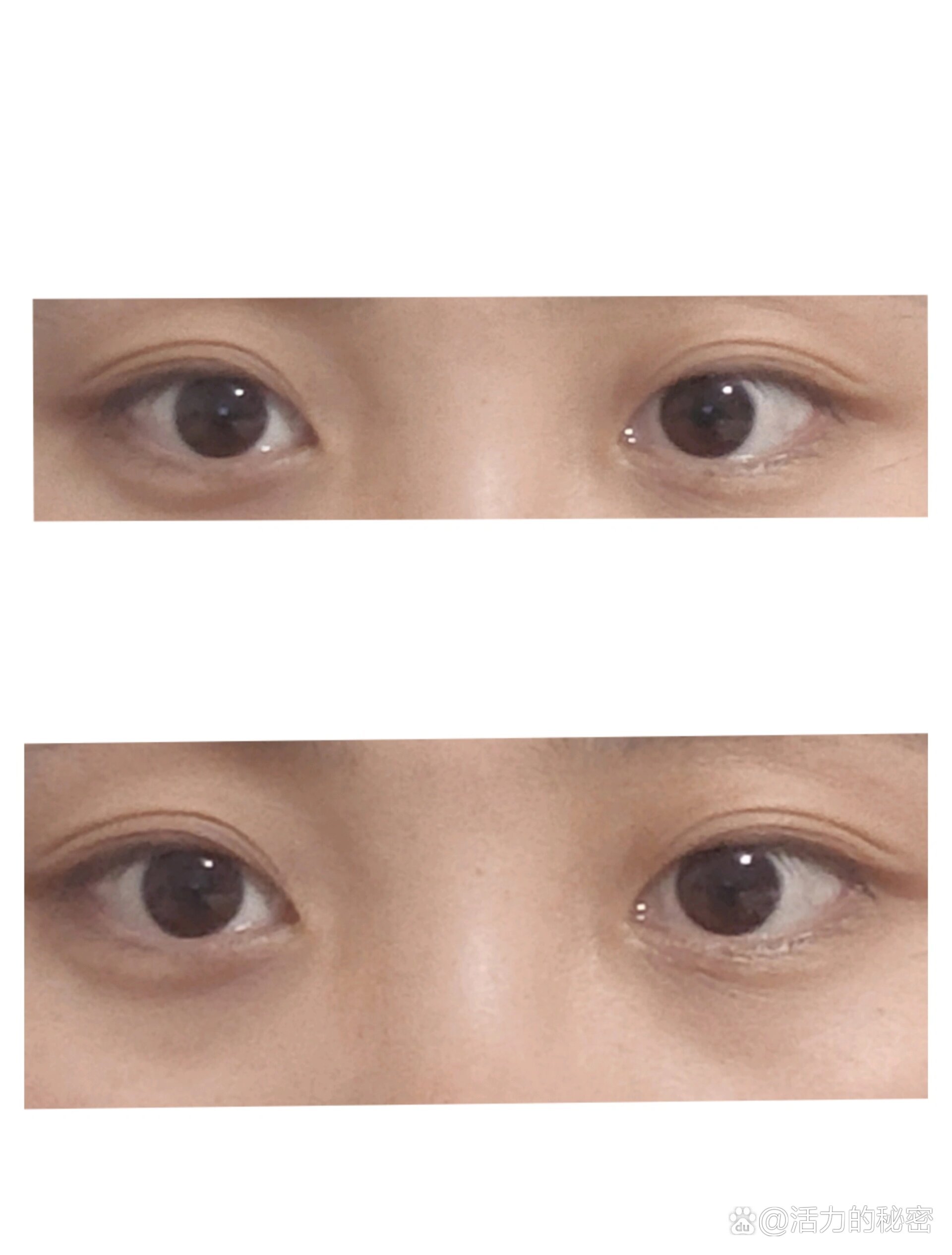 斗鸡眼:每天练习 br>问题1:左右黑眼珠偏上 br>问题2:右眼内斜严重