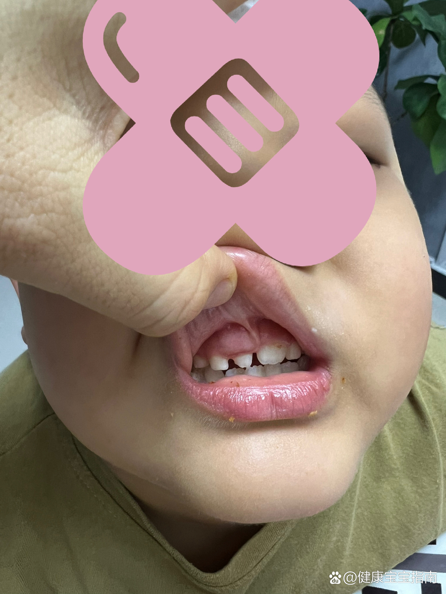 为什么会长多生牙 我23岁为什么在线 为什么会长多生牙 我23岁为什么在线