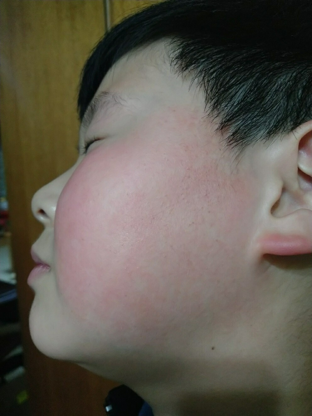 毛周角化(脸发红型)治疗记录第四天