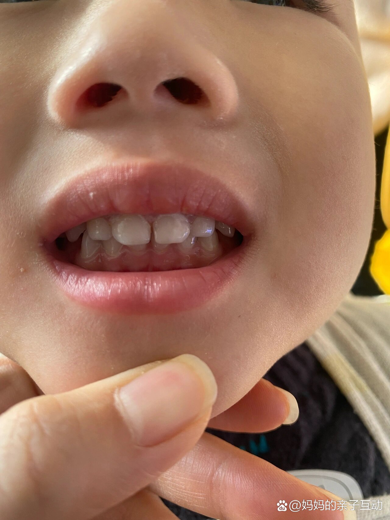 三周宝宝门牙得了龋齿怎么办