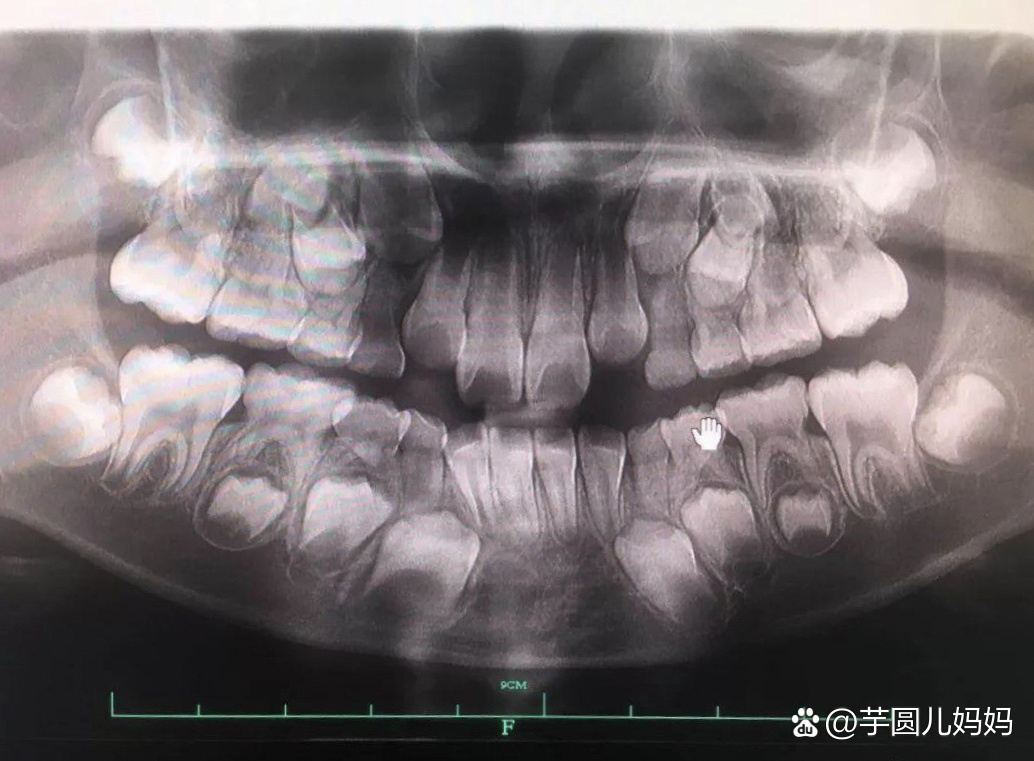 儿童看牙|拍片能够清晰的看到宝宝牙齿状态
