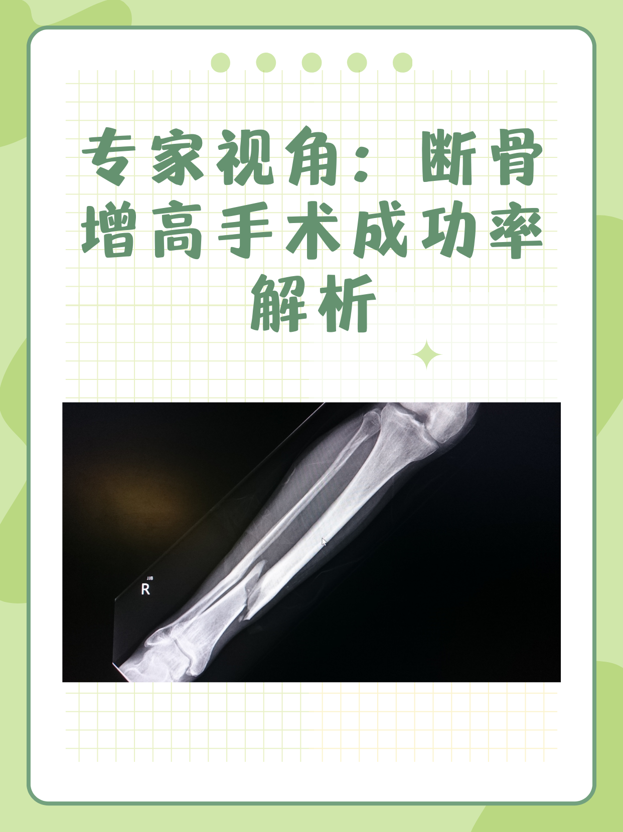 专家视角:断骨增高手术成功率解析