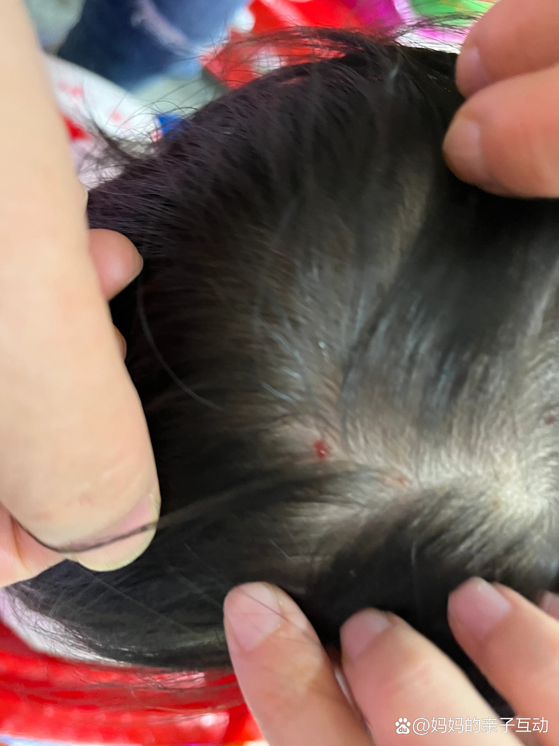 求助宝宝头皮痒长红色痘痘