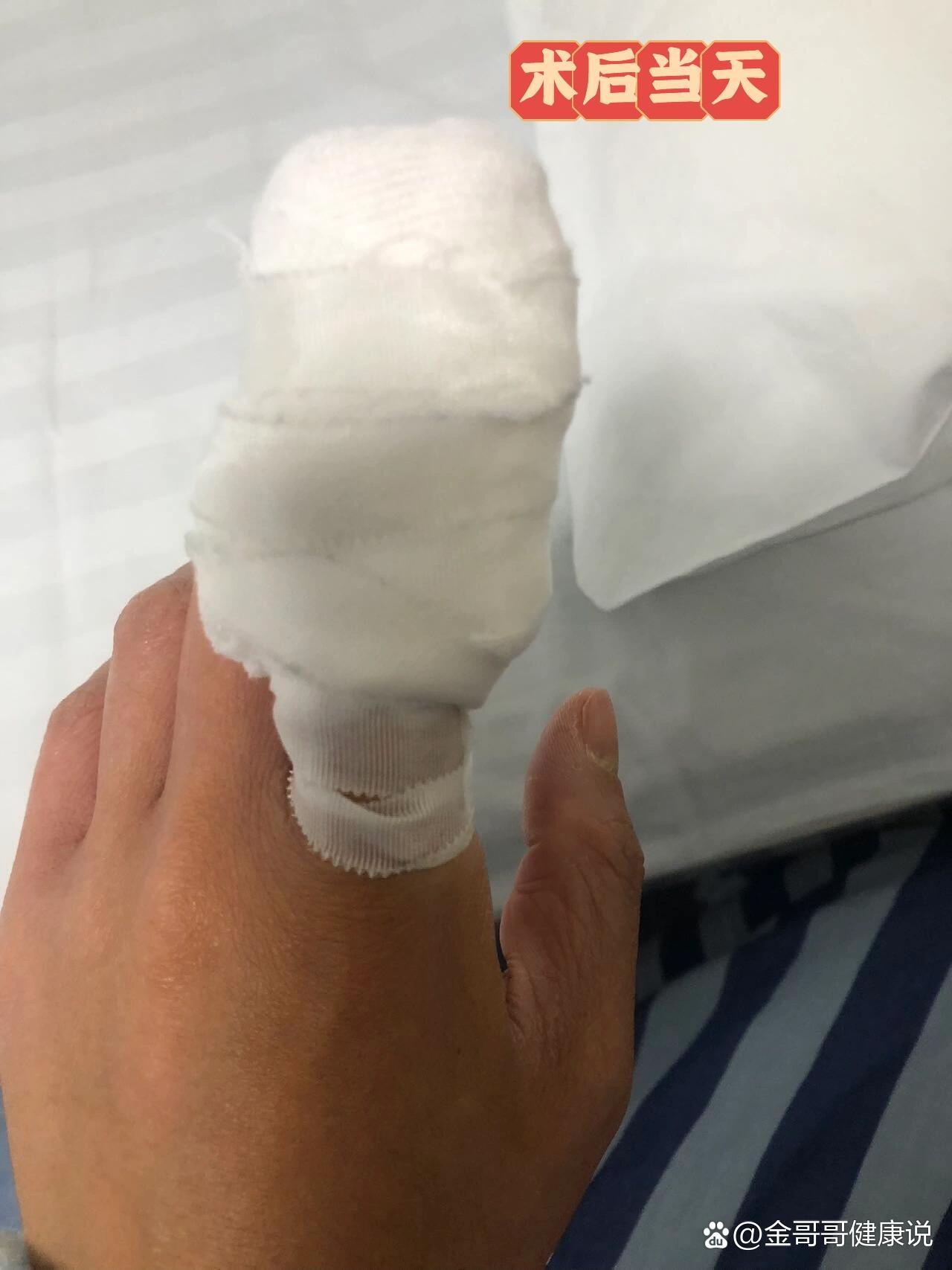 腱鞘巨细胞瘤