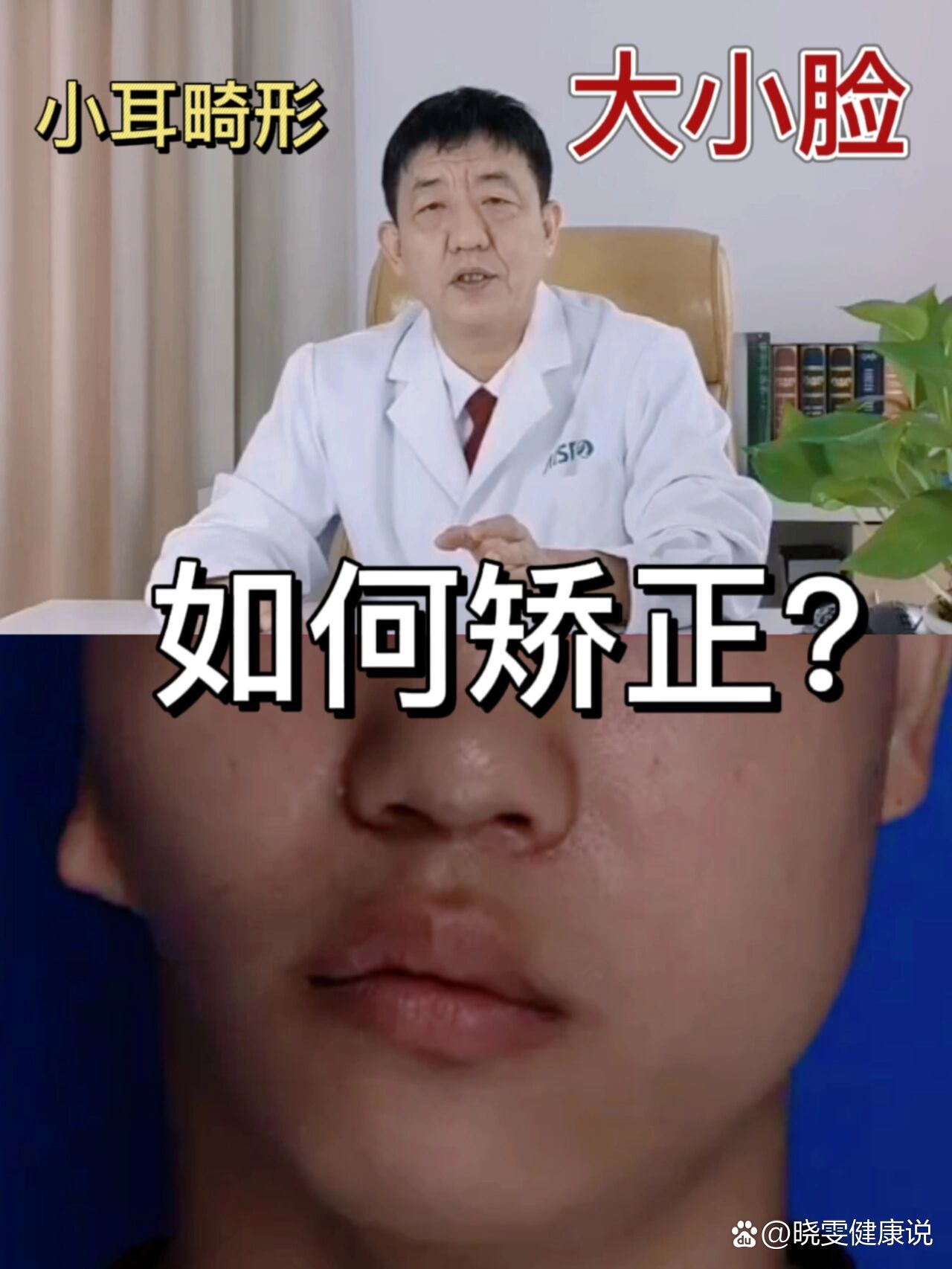 小耳畸形伴随面部畸形(大小脸)怎么办