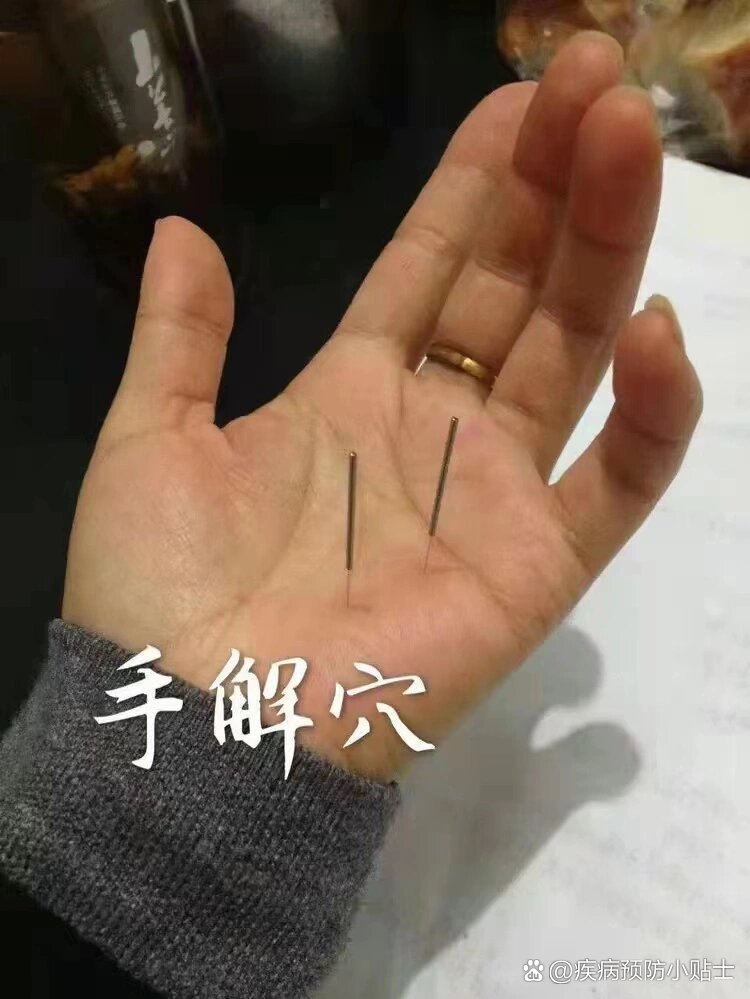 针灸手上位置图图片