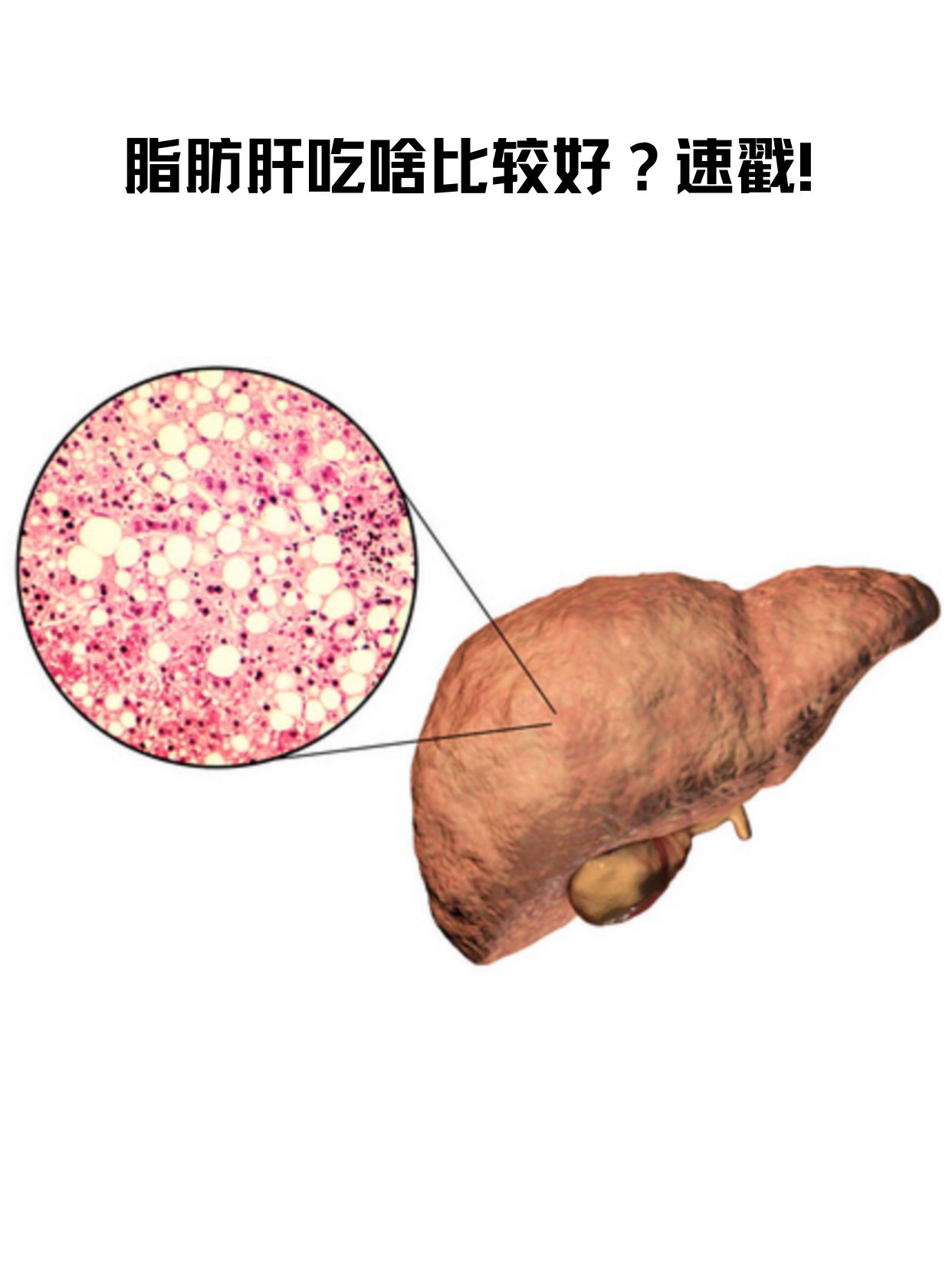 脂肪肝最怕三种食物图片