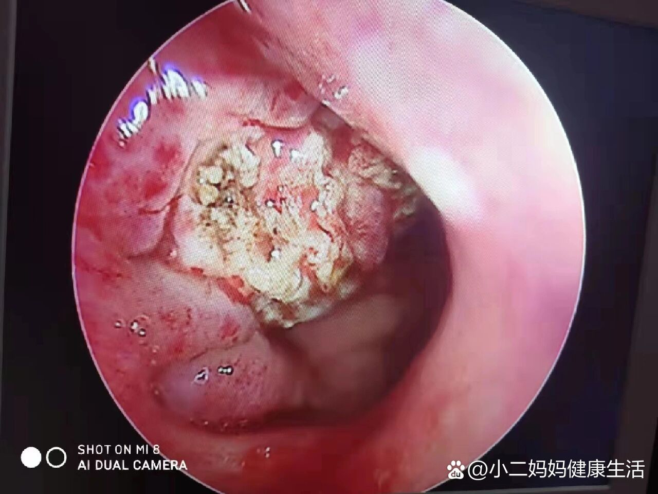 腺样体肥大,前后对比