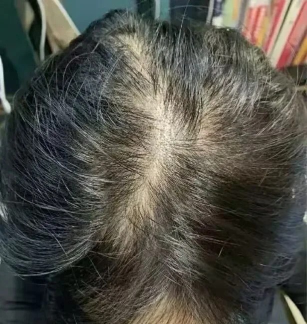 脂溢性脱发终于治好了,公布一下我的经验.