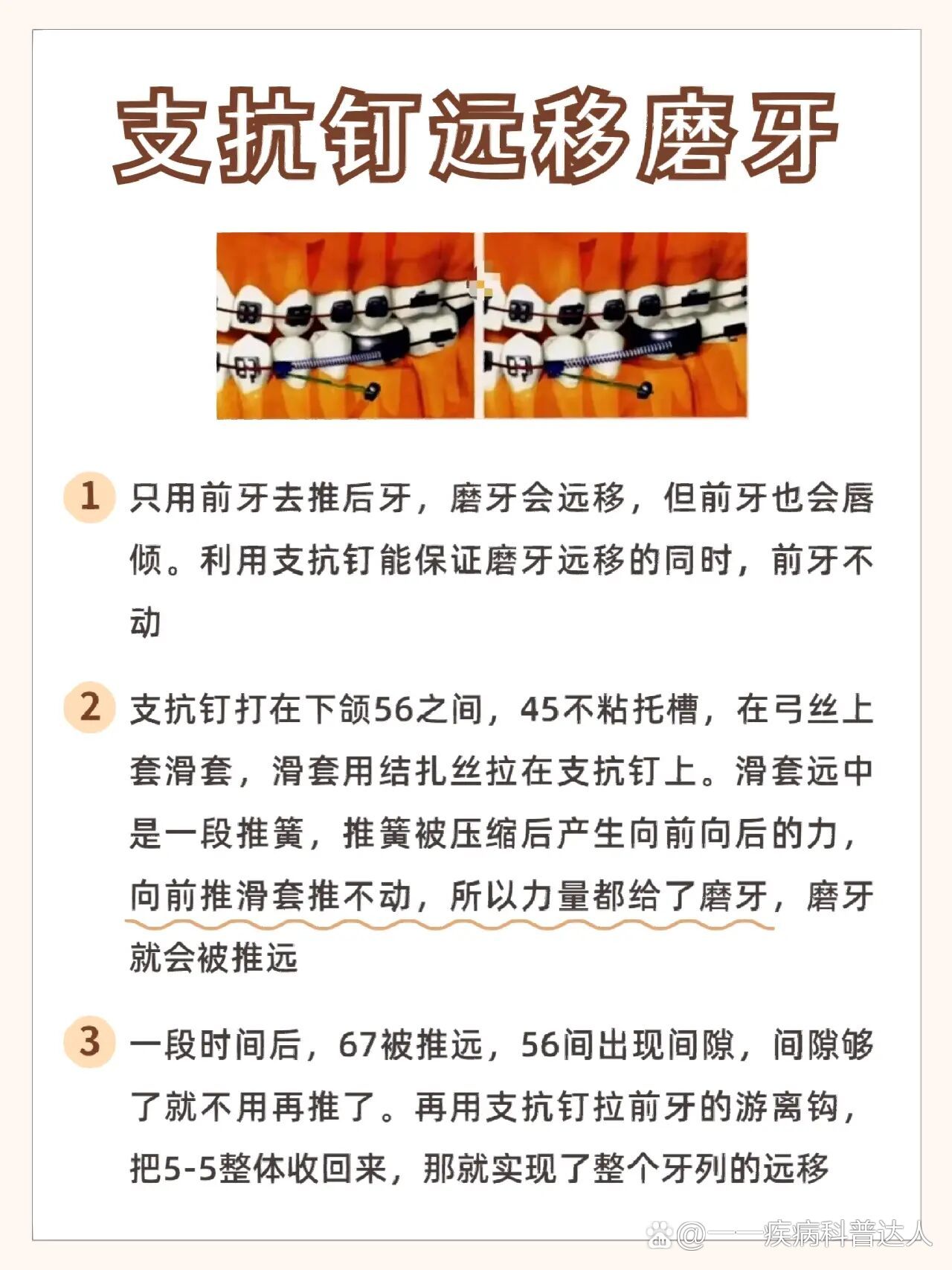 支抗钉远移磨牙