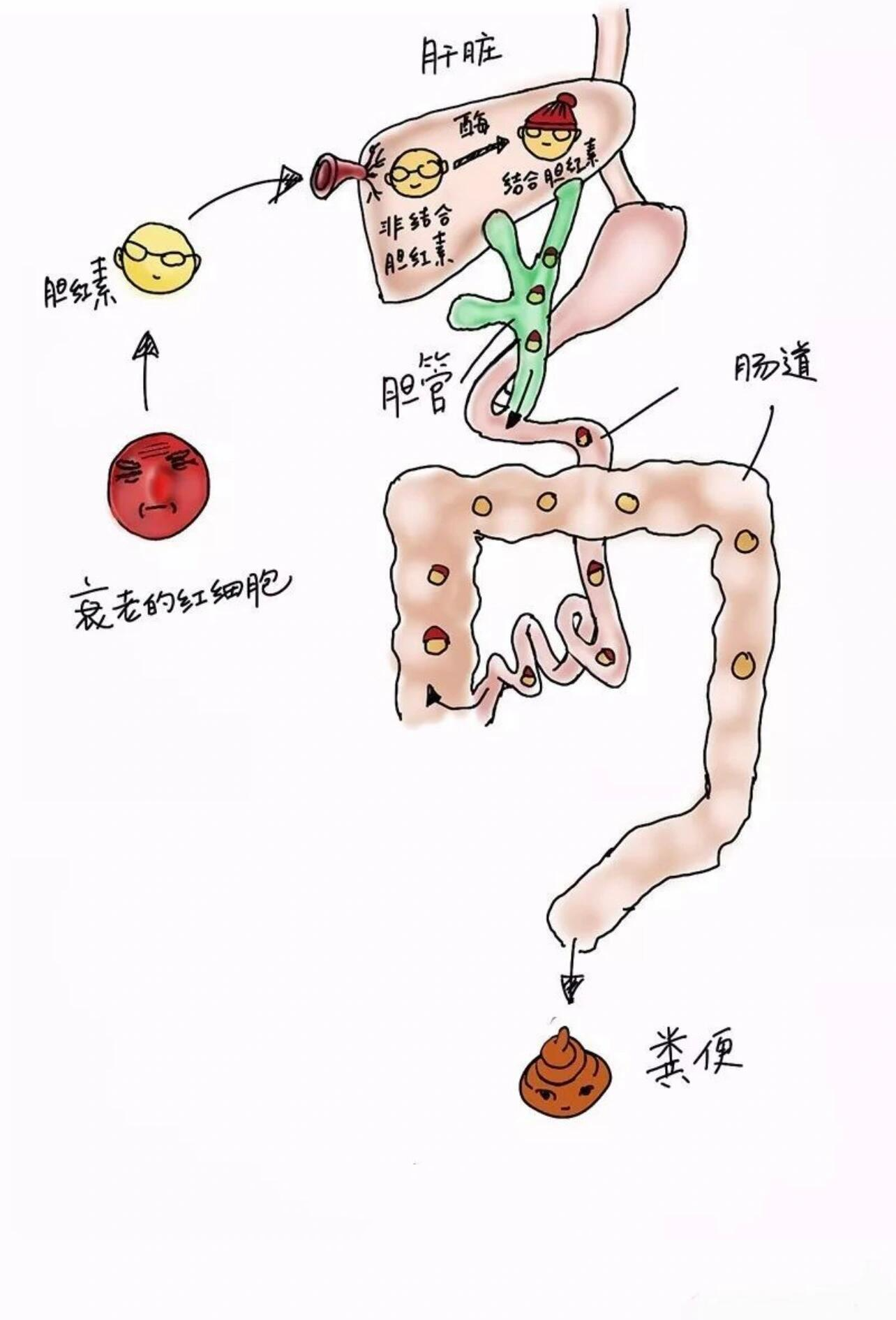 溶血性黄疸病人图片图片