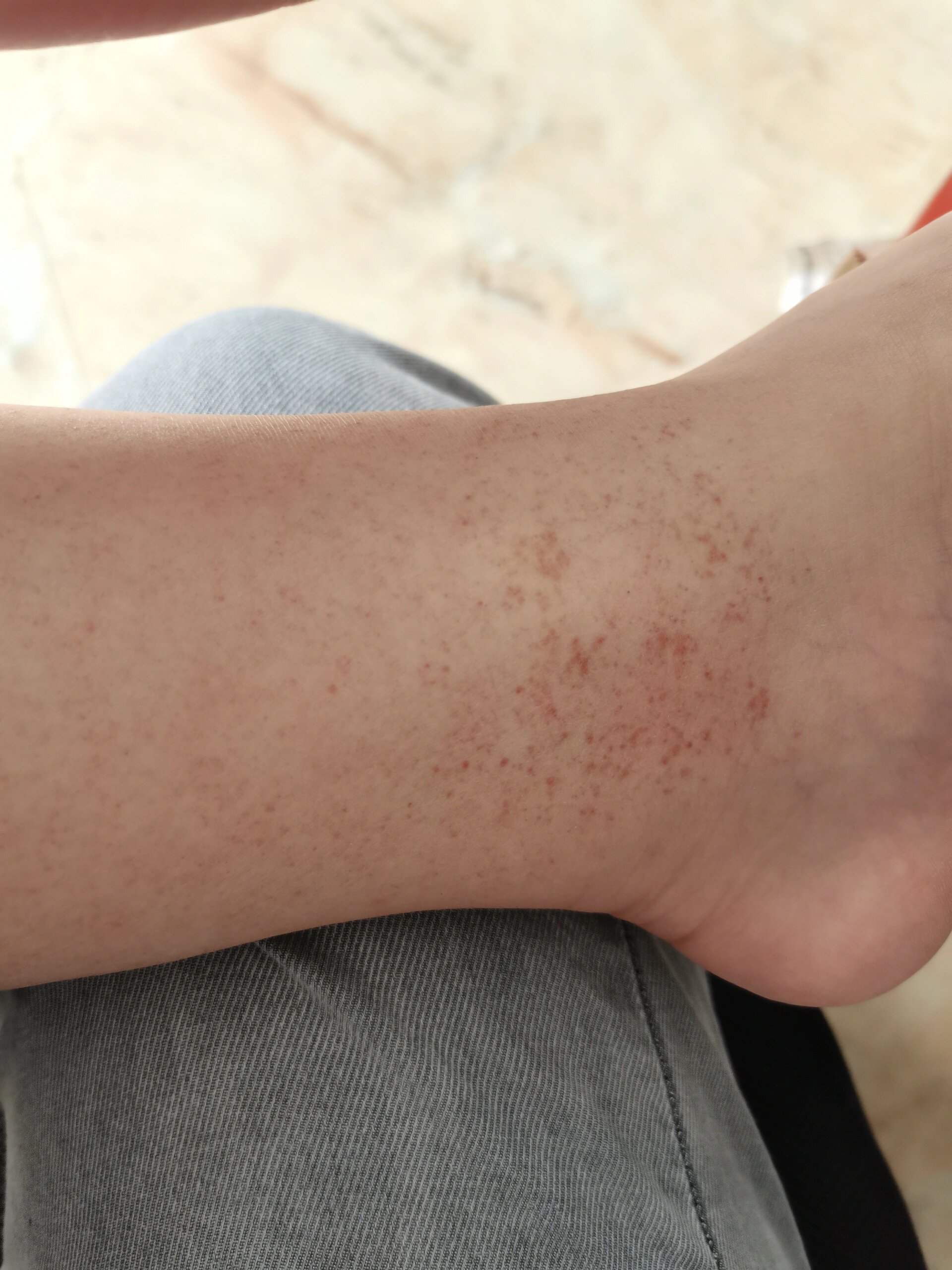 脚裸长小红点是什么?