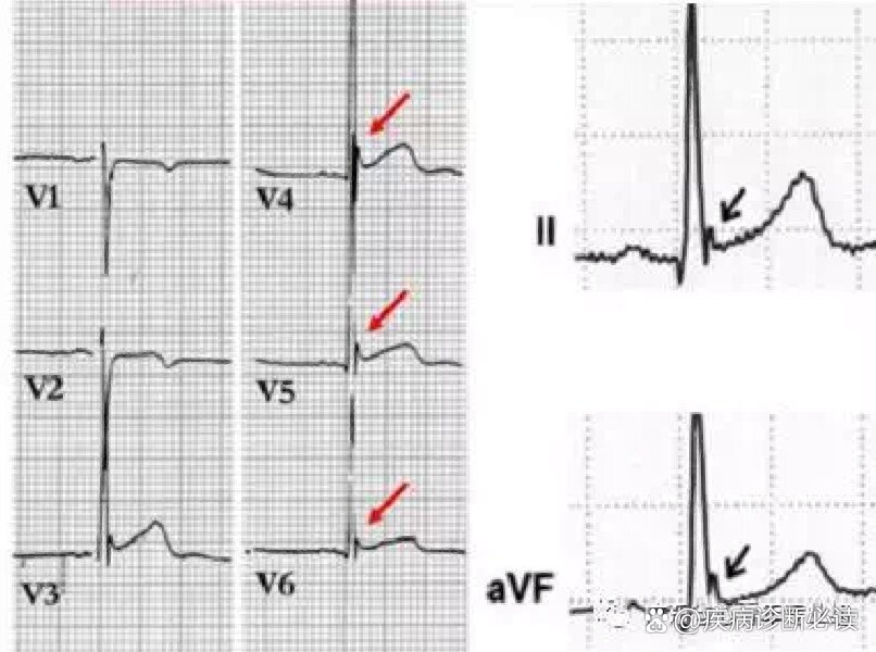 早期复极心电图图片