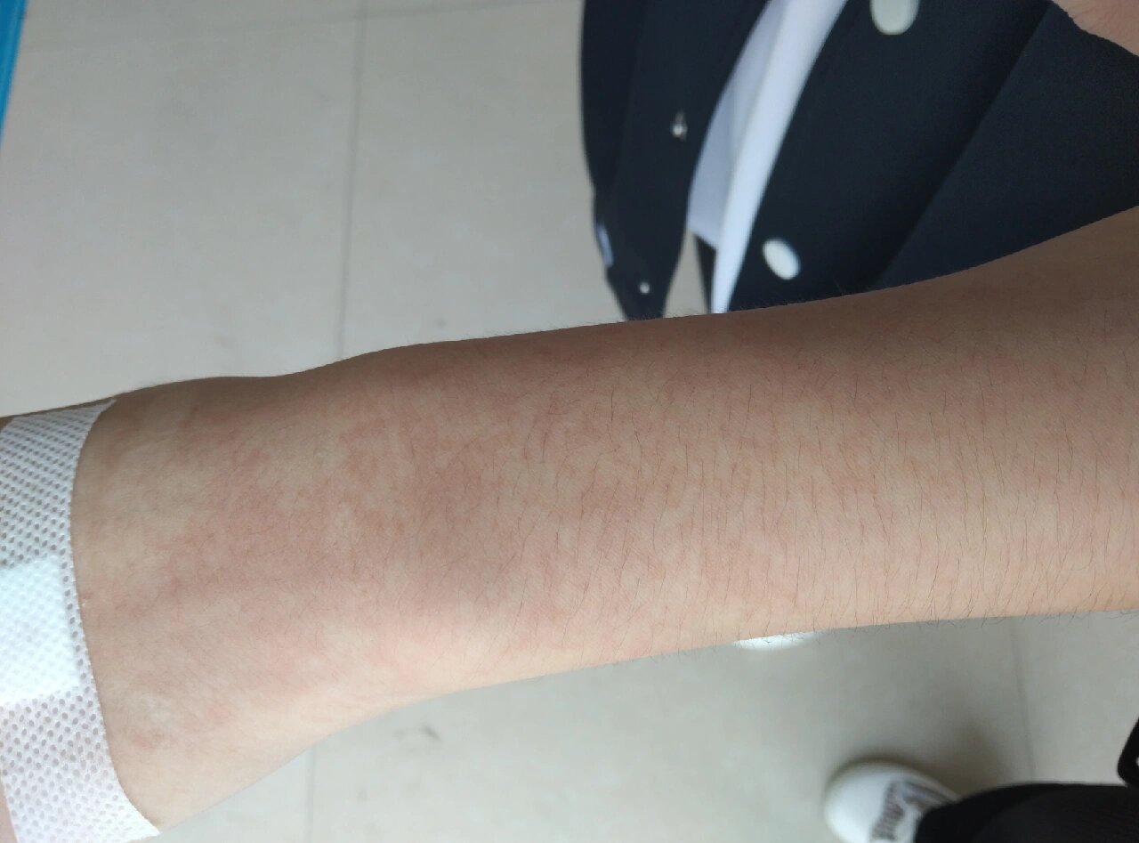 条索状红线//静脉炎