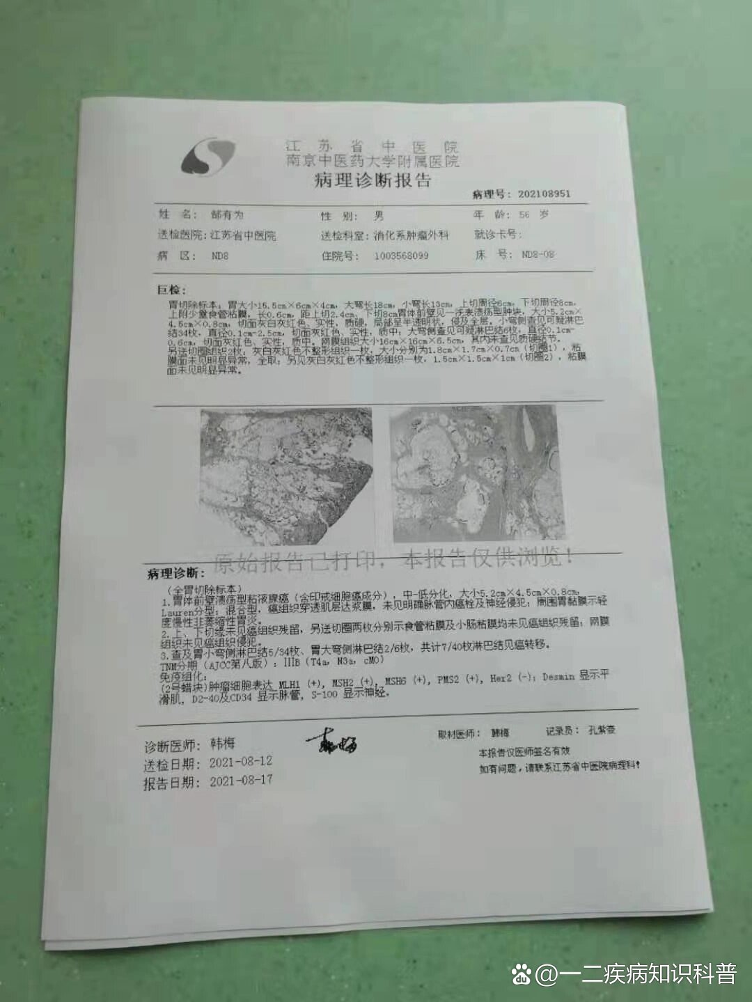确认胃癌中晚期