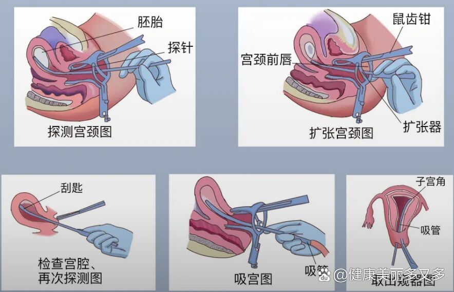 无痛人流手术过程照片图片