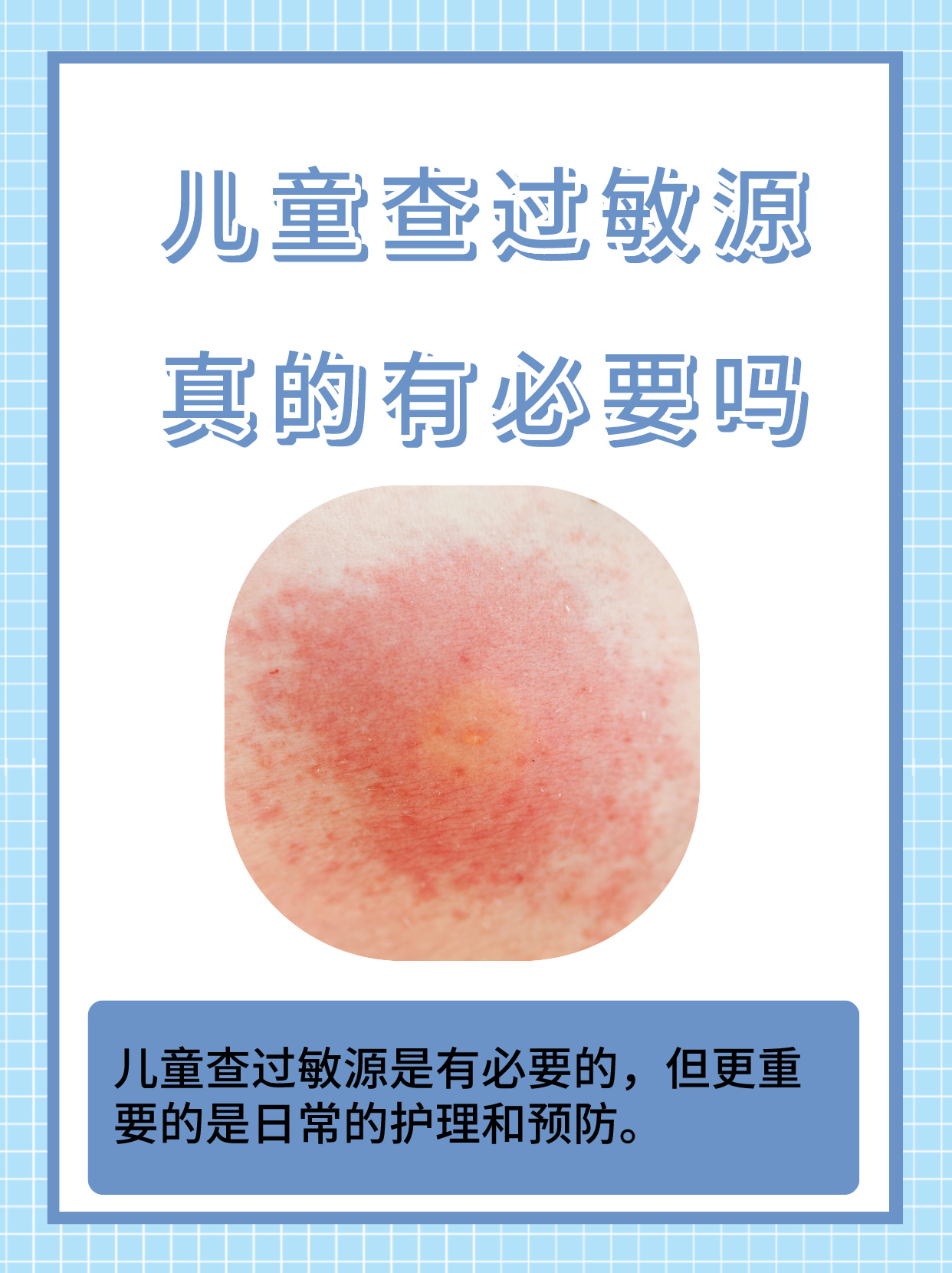 儿童查过敏源,真的有必要吗?