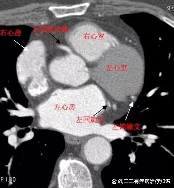 02心脏ct解剖图