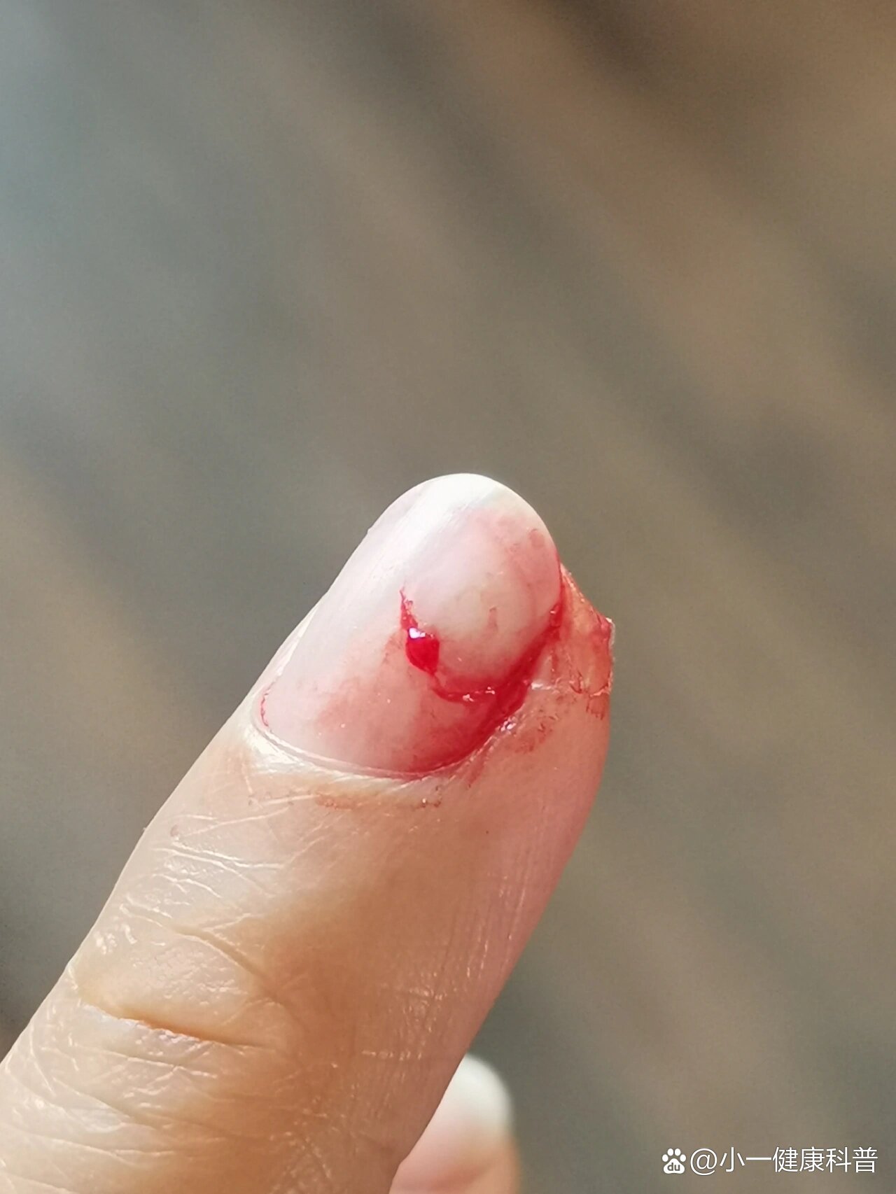 痛死了,切肉切到中指指甲了,真的超级疼!