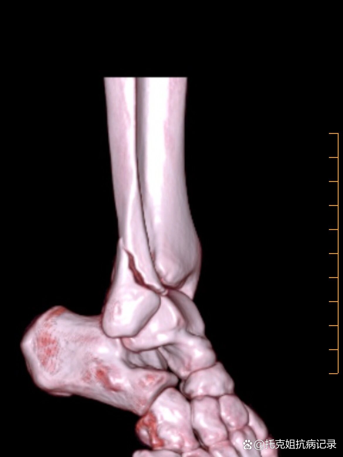 右腓骨外踝骨折图片图片