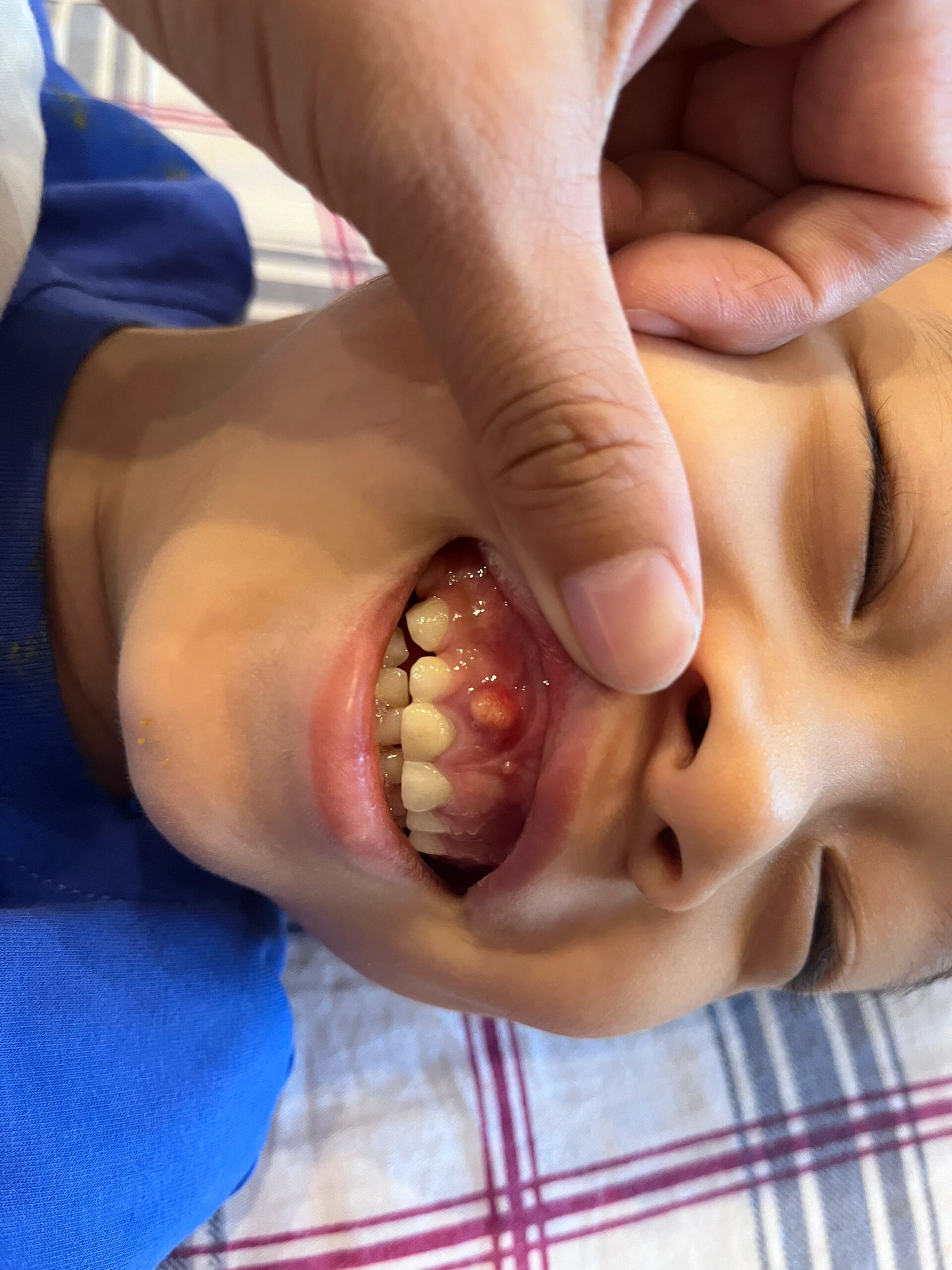 孩子牙龈上面长了一个包