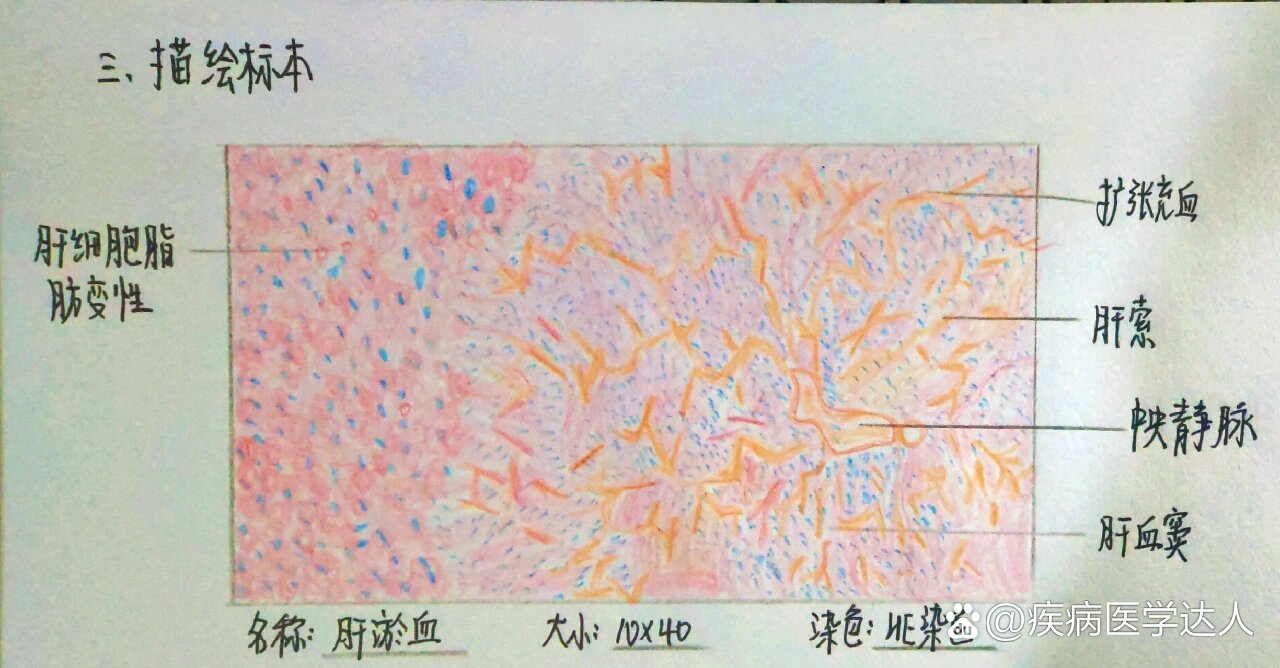 鼻息肉病理红蓝手绘图图片