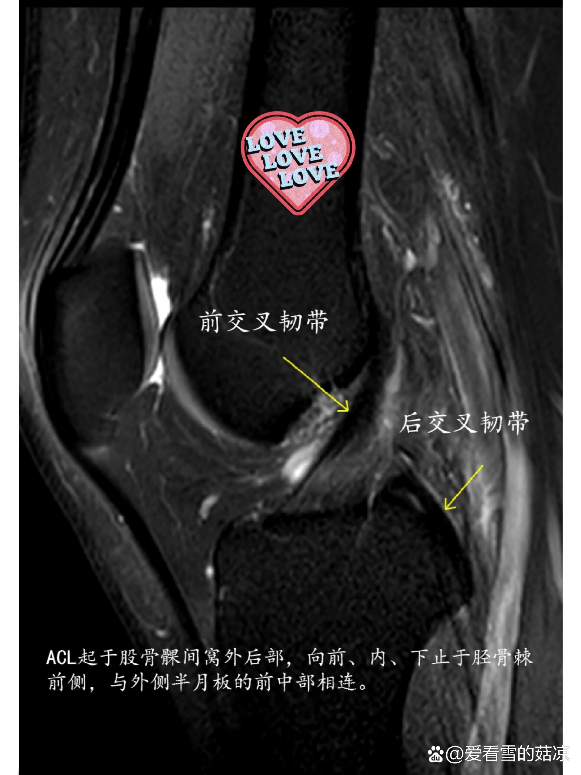 正常膝关节髁间棘图片图片