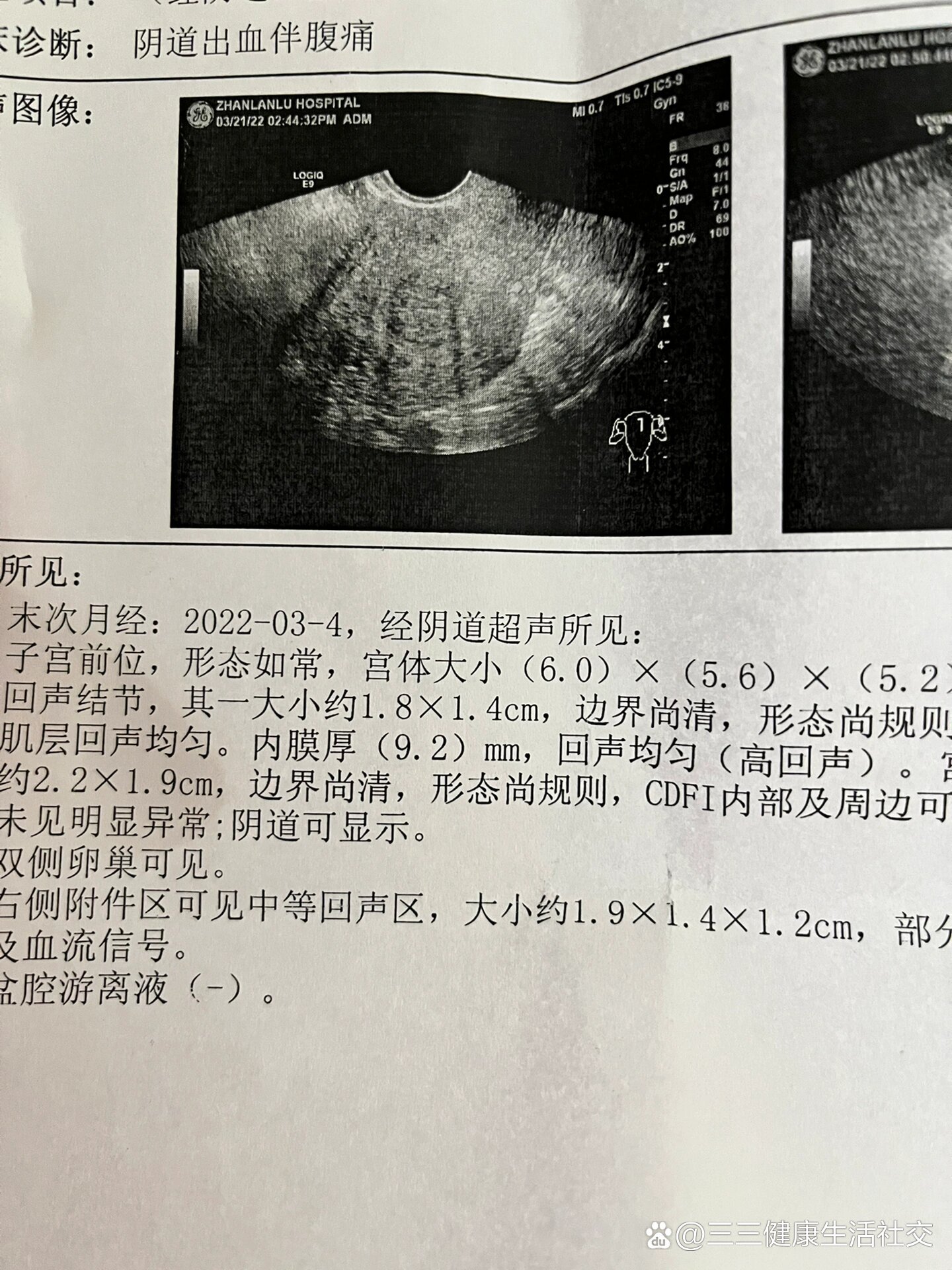 肚子胀气厉害想放屁,腰酸有缓解,还在持续出血中,但是感觉血量有所