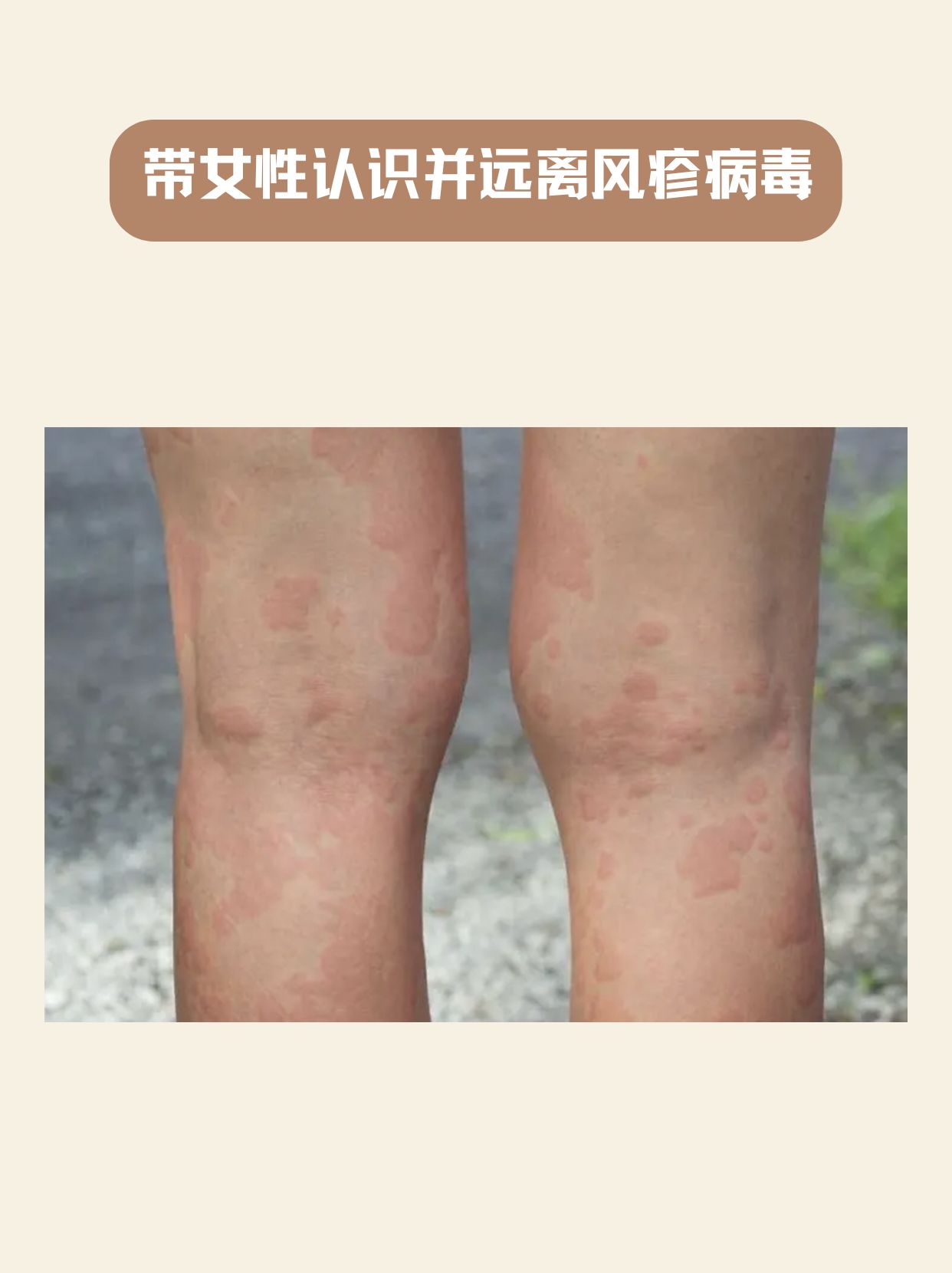 带女性认识并远离风疹病毒