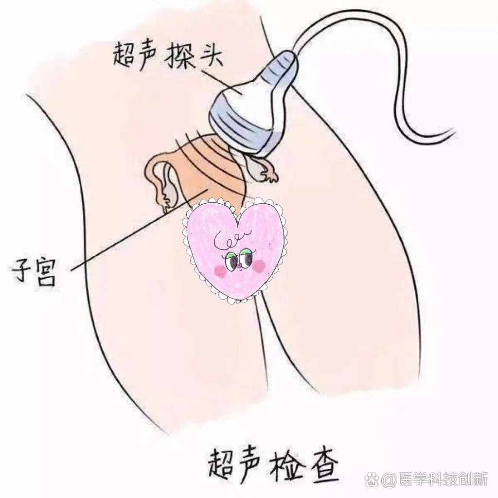 为什么我不推荐做阴超?