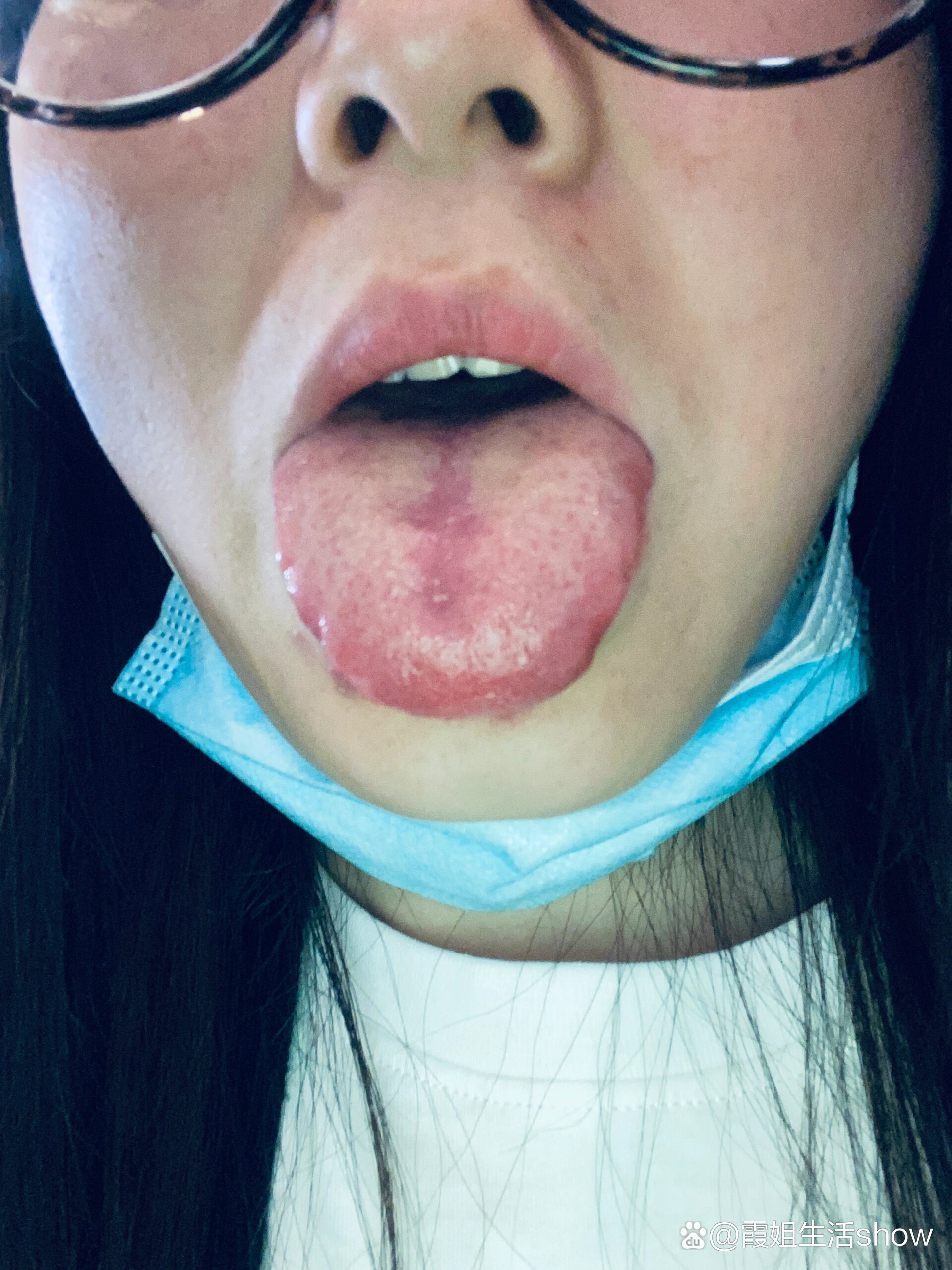修正养脾散 枳实消痞丸