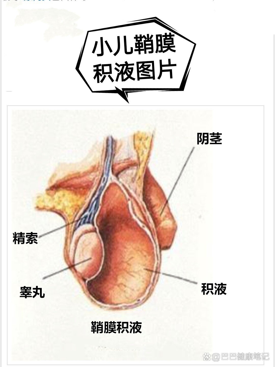 新生儿鞘膜积液图片图片