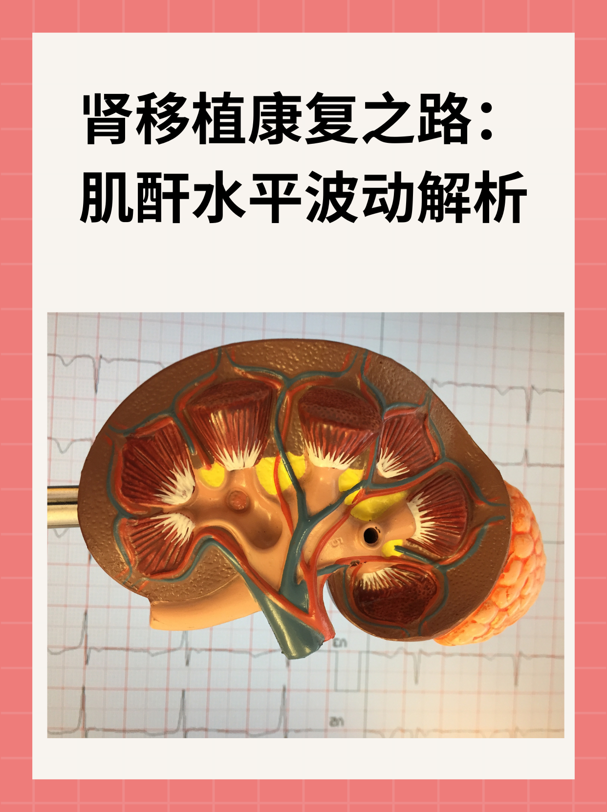 移植肾的位置图片图片