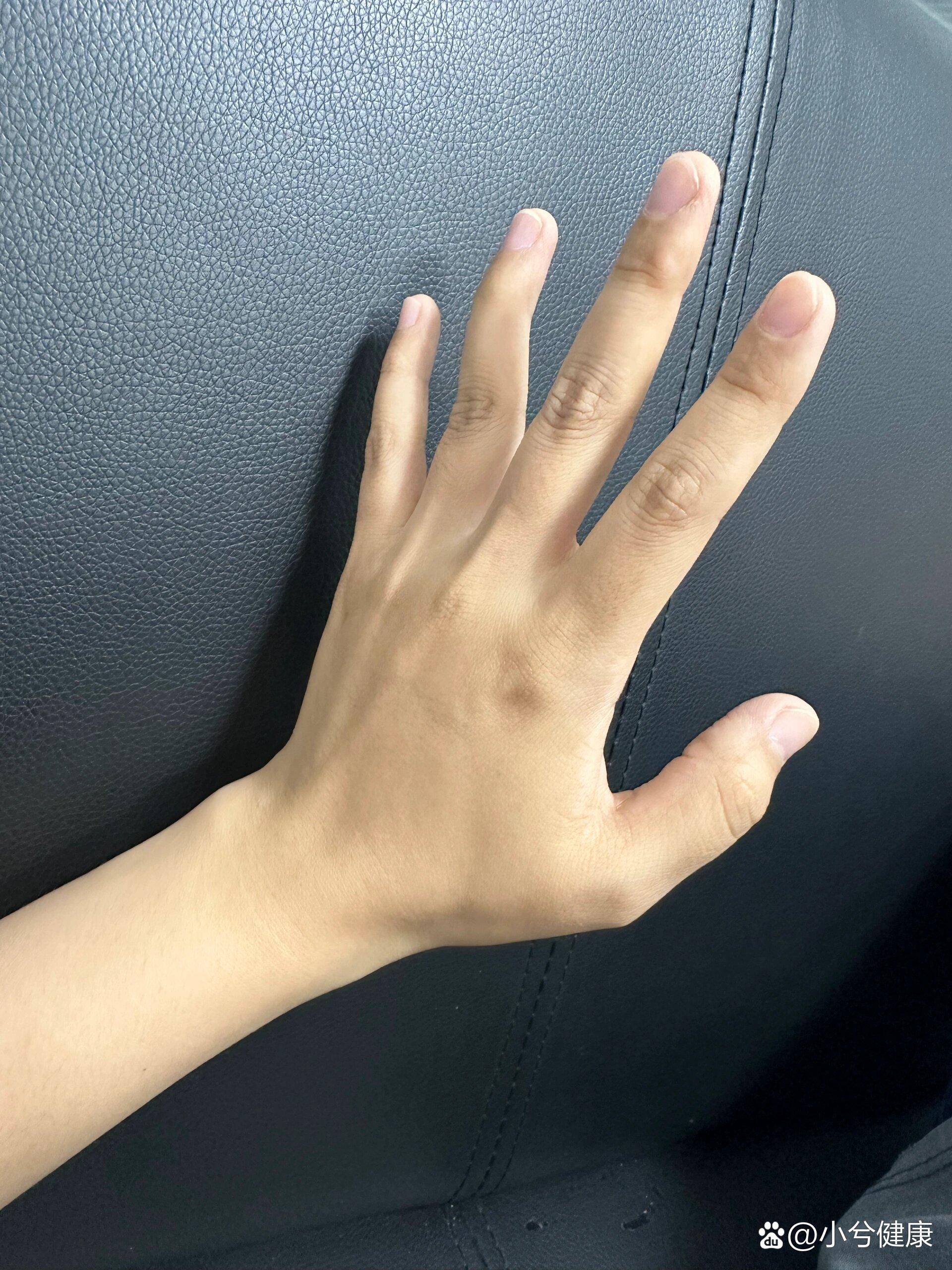 生完娃手指就歪了