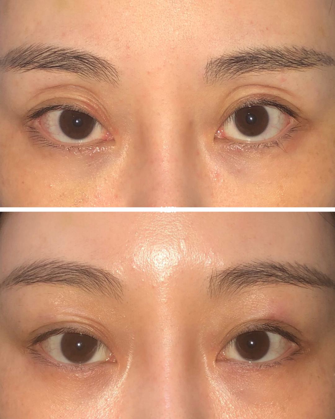 什么原因会出现眼窝凹陷呢,该如何改善眼窝凹陷?