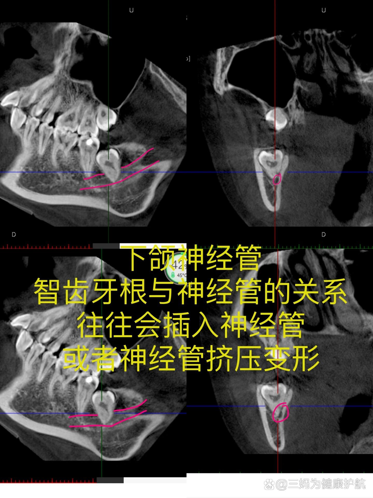 前为什么要拍牙科ct,是因为我们需要看智齿牙根与下颌神经管的关系