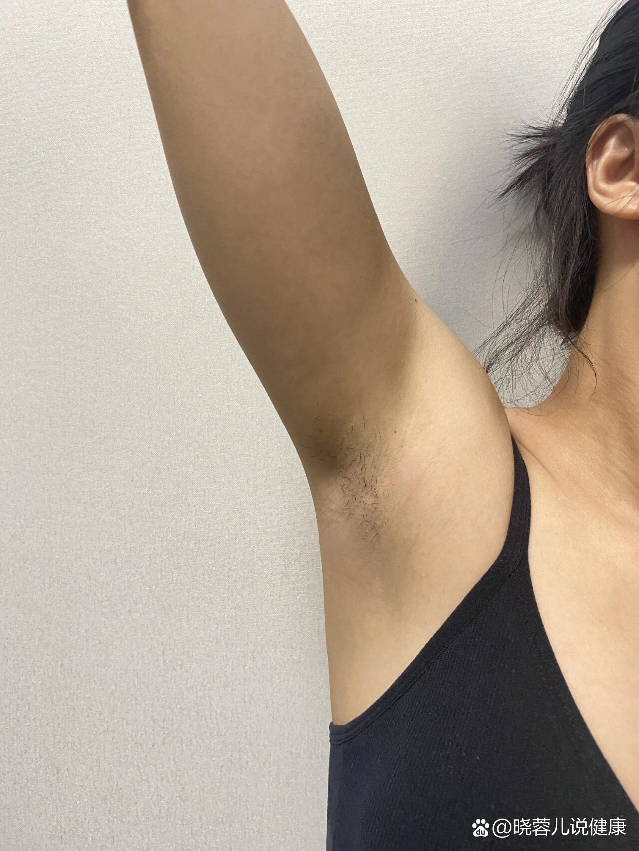 腋下脱毛有小黑点怎么办?