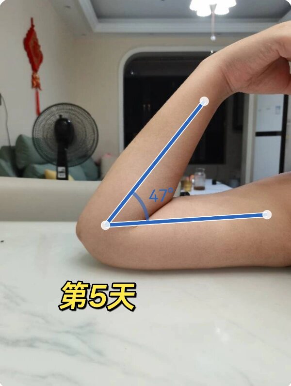 肘关节角度康复训练第5天