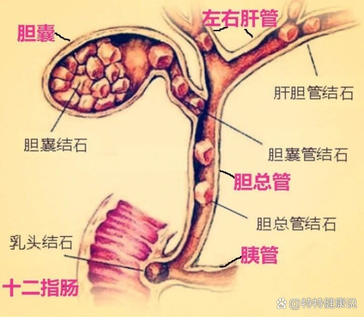 结石位置图片大全图片