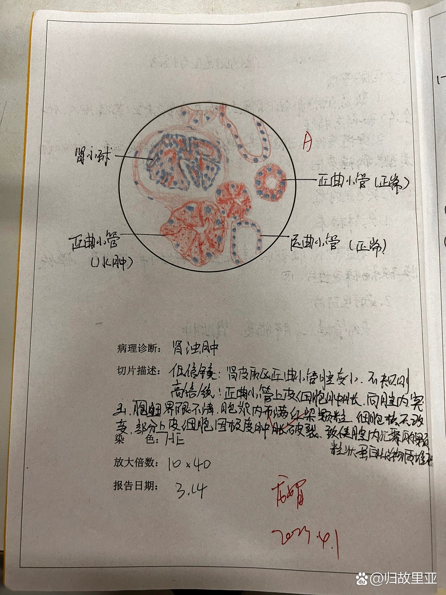 肾脓肿切片绘图图片